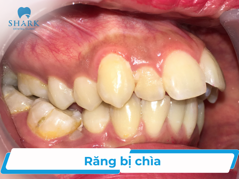 Răng bị chìa là gì? Khắc phục răng bị chìa thế nào?