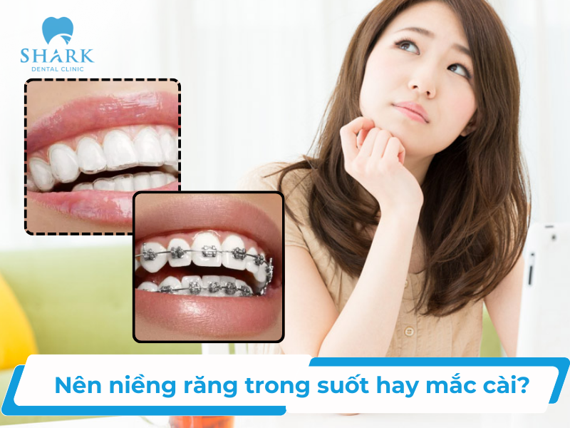 Nên niềng răng trong suốt hay mắc cài để đạt hiệu quả tốt?