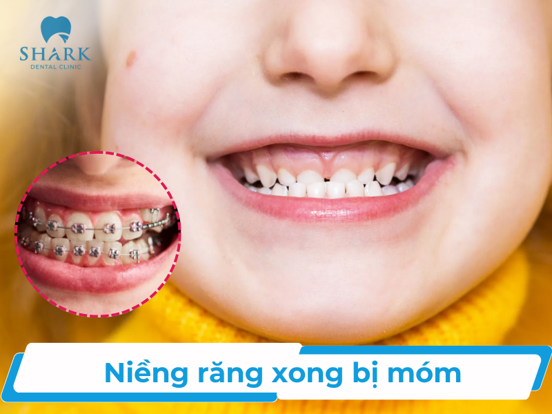 Niềng răng xong bị móm: Nguyên nhân và cách khắc phục