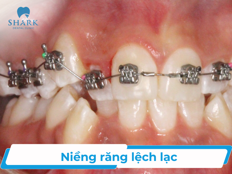Niềng răng lệch lạc - Các phương pháp niềng hiệu quả