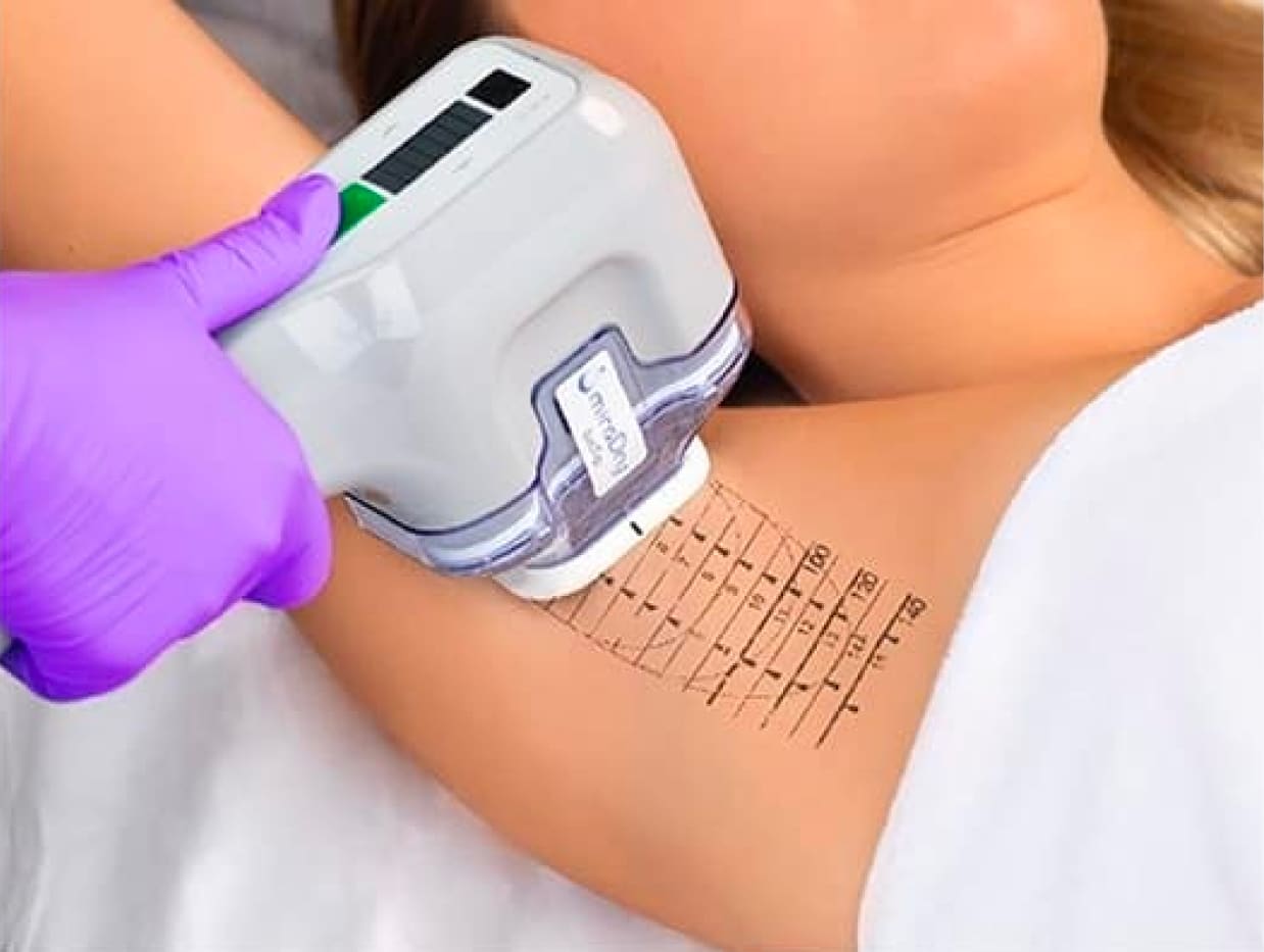 A comprehensive overview of underarm sweat treatment – symptoms, proce -