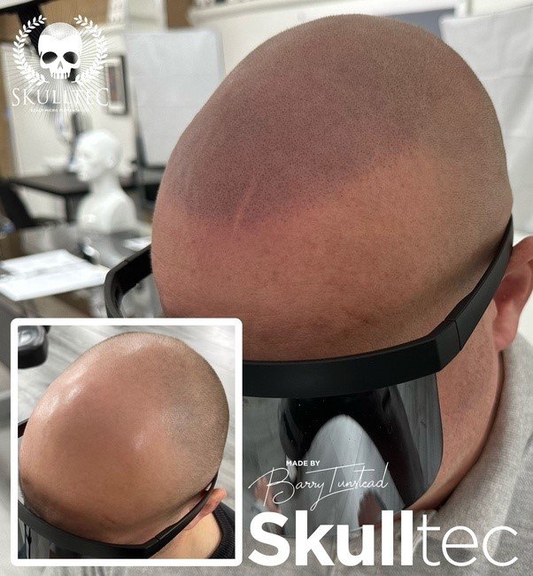 How Can I Find Affordable Hair Scalp Micropigmentation Cost Without Compromising Quality?