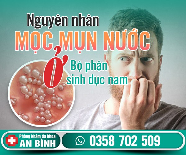 Mọc mụn nước ở bộ phận sinh dục nam chớ xem thường
