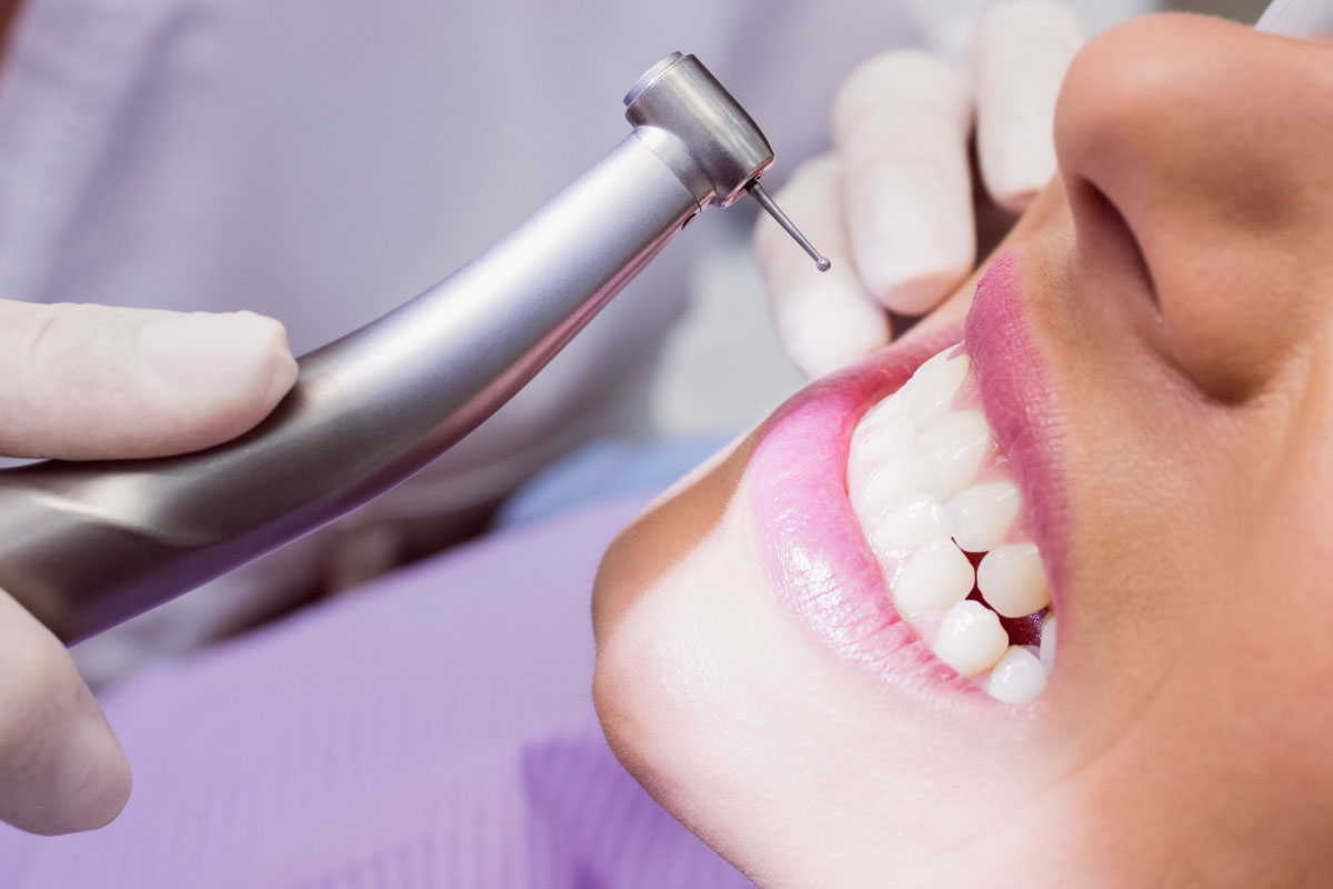 Dental Crowns Mississauga, ON - Dental Fillings and Veneers