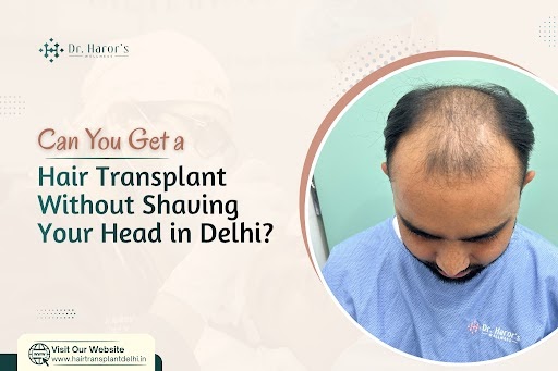 Can You Get a Hair Transplant Without Shaving Your Head in Delhi?