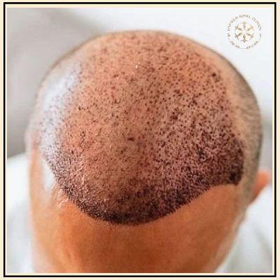 Hair Transplant in Islamabad, Pakistan
